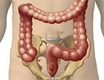 Nettoyage du colon : la plaque mucoïde...